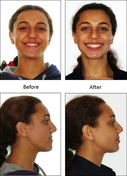 Corrective Jaw Surgery (Orthognathic)