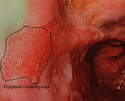 Barrett's with dysplasia annotated