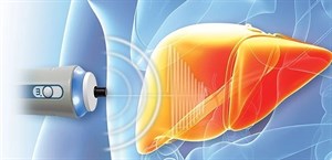 Fibroscan